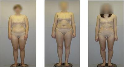 Perceptual Not Attitudinal Factors Predict the Accuracy of Estimating Other Women’s Bodies in Both Women With Anorexia Nervosa and Controls